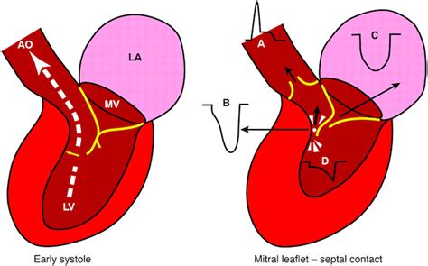 lv outflow tract|left ventricular outflow obstruction management.